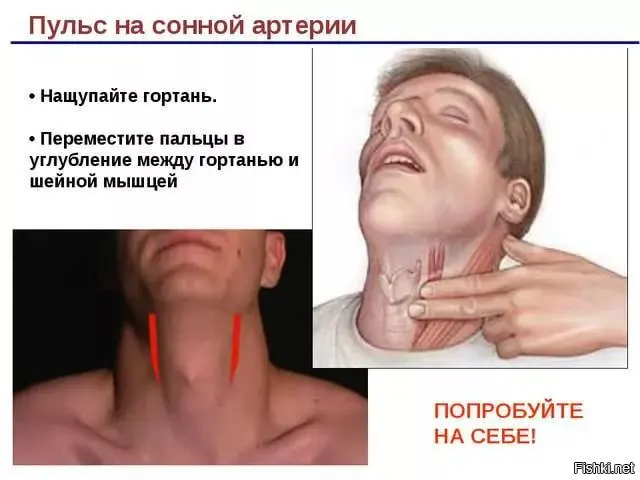 Carotid pulse.webp