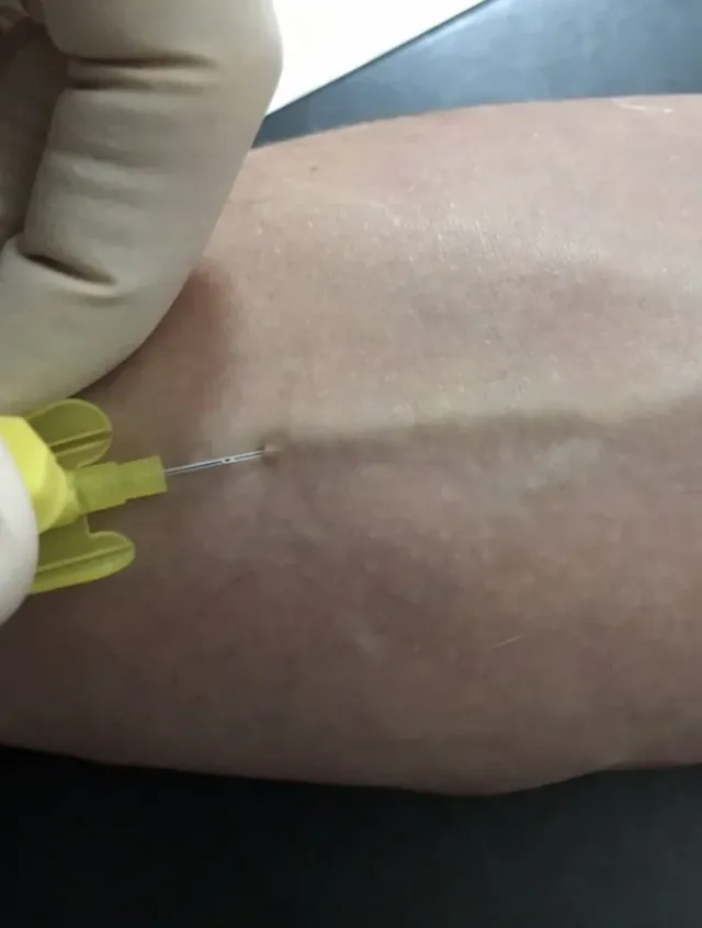 Пациент с установленным катетером для капельницы