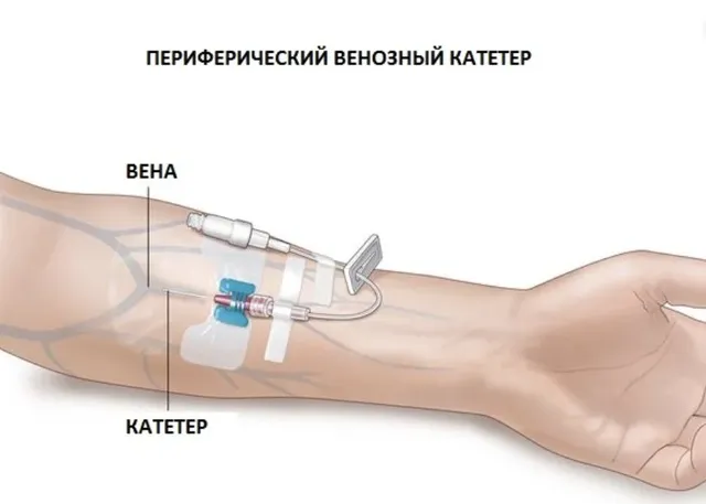 Схема установки венозного катетера