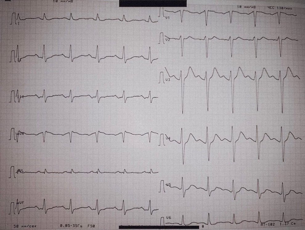 Введение 400 мг мефедрона однократно и регистрация ЭКГ 2.jpg