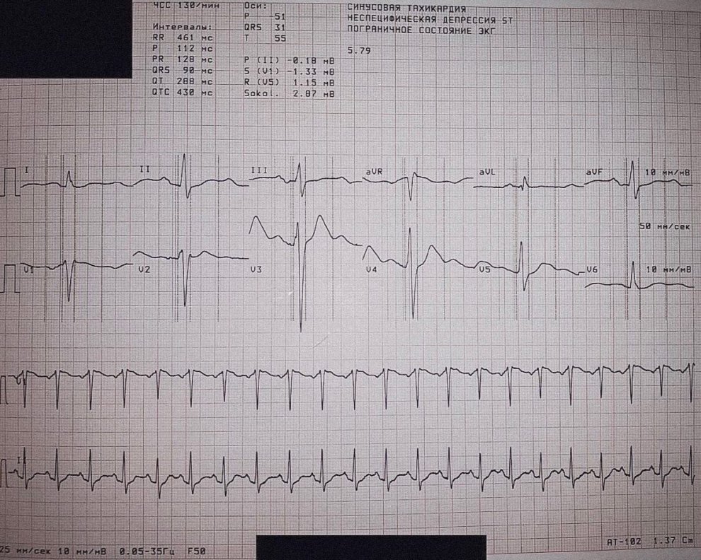 Введение 400 мг мефедрона однократно и регистрация ЭКГ.jpg